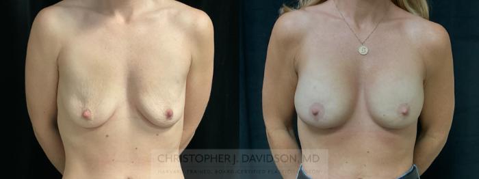 Breast Lift with Implants Case 375 Before & After Front | Boston, MA | Christopher J. Davidson, MD