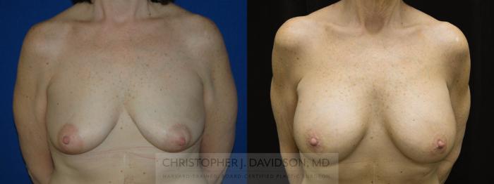 Breast Lift with Implants Case 41 Before & After View #1 | Boston, MA | Christopher J. Davidson, MD