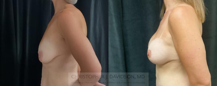 Breast Lift with Implants Case 458 Before & After Left Side | Boston, MA | Christopher J. Davidson, MD