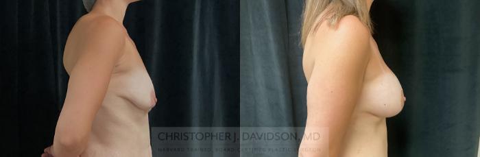 Breast Lift with Implants Case 458 Before & After Right Side | Boston, MA | Christopher J. Davidson, MD