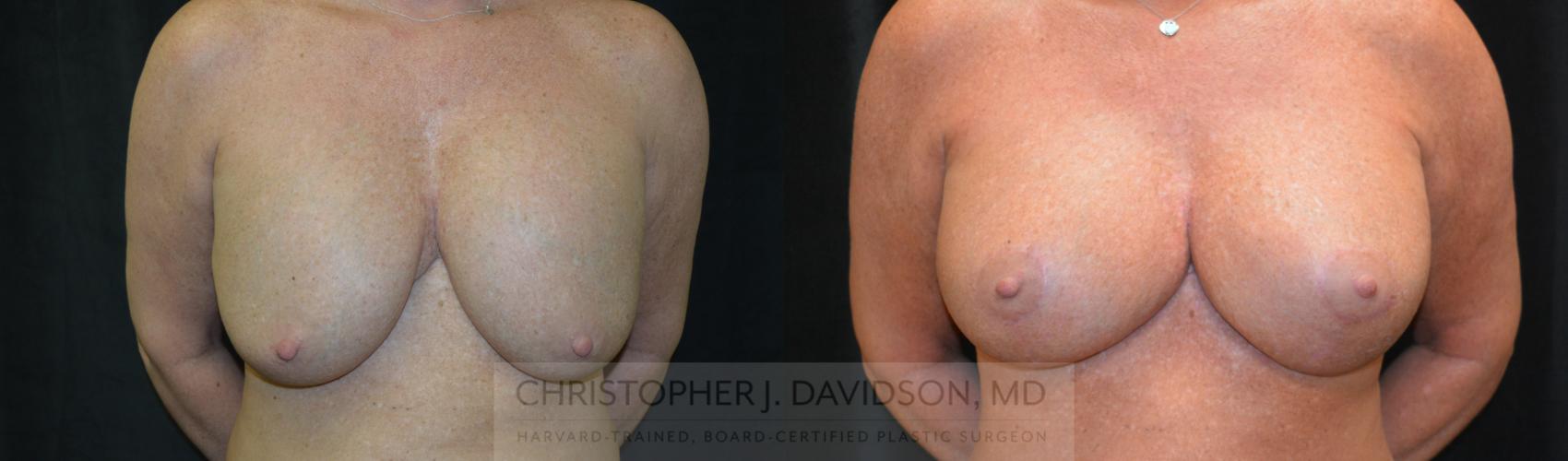 Breast Augmentation Revision Case 464 Before & After Front | Boston, MA | Christopher J. Davidson, MD