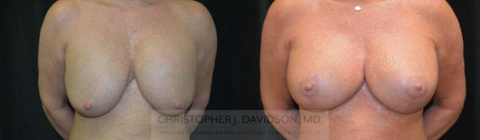 Breast Lift with Implants Case 464 Before & After Front | Boston, MA | Christopher J. Davidson, MD