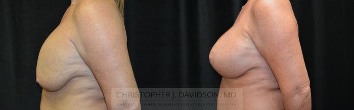Breast Augmentation Revision Case 464 Before & After Left Side | Boston, MA | Christopher J. Davidson, MD