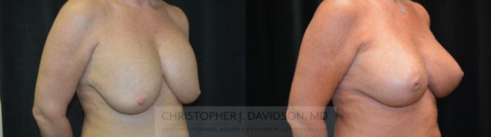 Breast Augmentation Revision Case 464 Before & After Right Oblique | Boston, MA | Christopher J. Davidson, MD