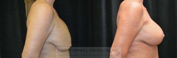 Breast Augmentation Revision Case 464 Before & After Right Side | Boston, MA | Christopher J. Davidson, MD