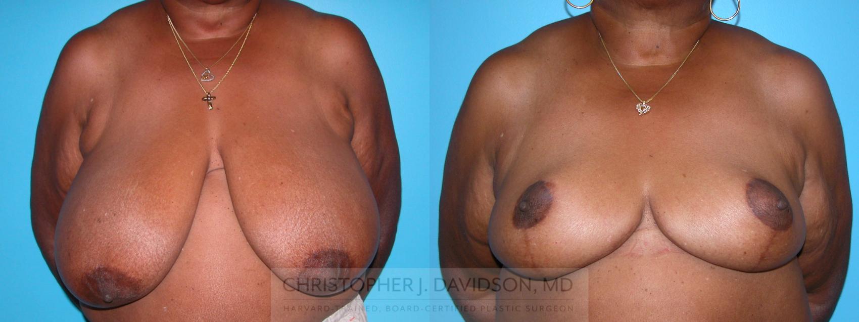 Breast Reduction Case 133 Before & After View #1 | Boston, MA | Christopher J. Davidson, MD