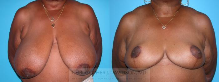 Breast Reduction Case 133 Before & After View #1 | Wellesley, MA | Christopher J. Davidson, MD