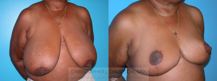 Breast Reduction Case 133 Before & After View #2 | Wellesley, MA | Christopher J. Davidson, MD