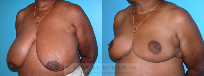 Breast Reduction Case 133 Before & After View #3 | Wellesley, MA | Christopher J. Davidson, MD