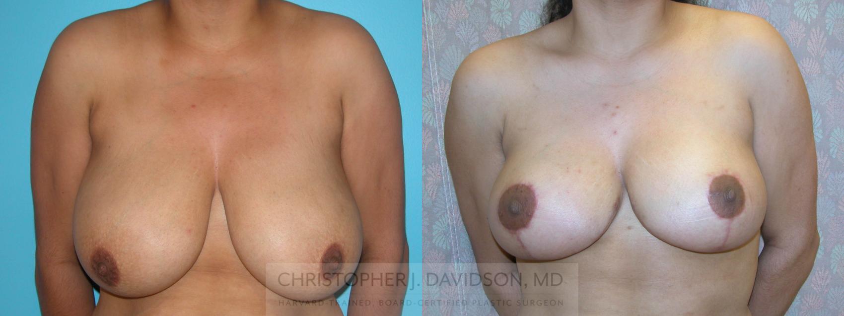 Breast Reduction Case 151 Before & After View #1 | Boston, MA | Christopher J. Davidson, MD