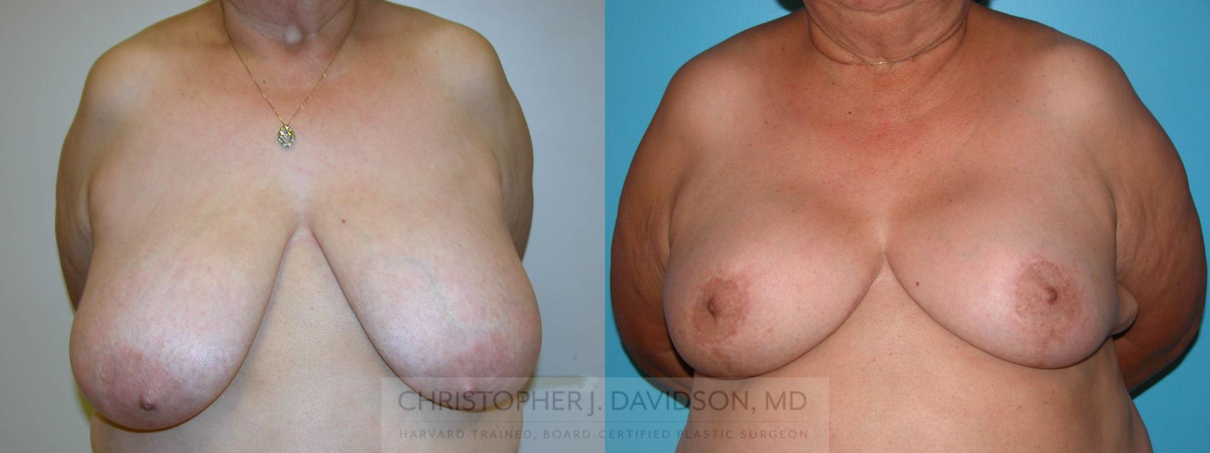 Breast Reduction Case 158 Before & After View #1 | Boston, MA | Christopher J. Davidson, MD