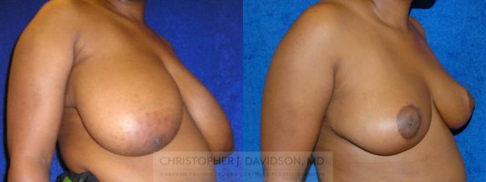 Breast Reduction Case 191 Before & After View #3 | Wellesley, MA | Christopher J. Davidson, MD