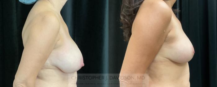 Breast Reduction Case 324 Before & After Right Side | Boston, MA | Christopher J. Davidson, MD