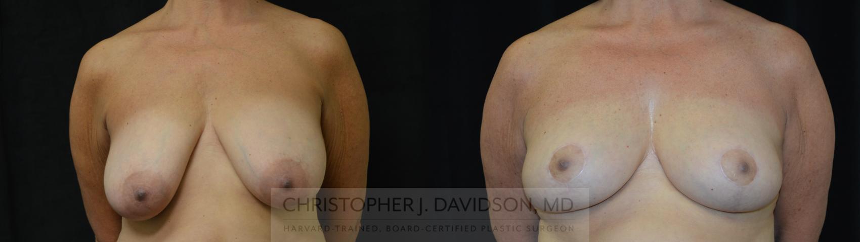 Breast Reduction Case 392 Before & After Front | Boston, MA | Christopher J. Davidson, MD