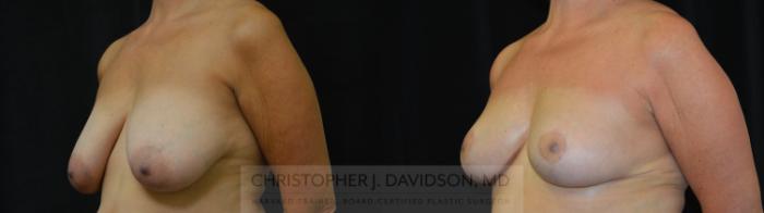 Breast Reduction Case 392 Before & After Left Oblique | Boston, MA | Christopher J. Davidson, MD