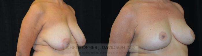 Breast Reduction Case 392 Before & After Right Oblique | Boston, MA | Christopher J. Davidson, MD