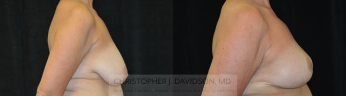 Breast Reduction Case 392 Before & After Right Side | Boston, MA | Christopher J. Davidson, MD