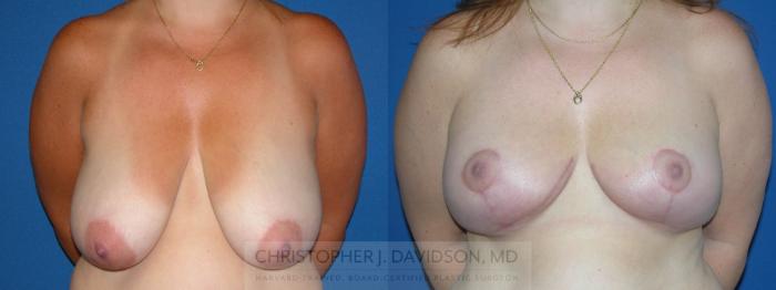 Breast Reduction Case 91 Before & After View #1 | Wellesley, MA | Christopher J. Davidson, MD