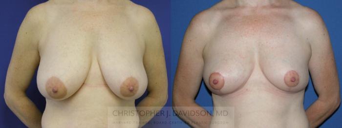 Breast Reduction Case 99 Before & After View #1 | Wellesley, MA | Christopher J. Davidson, MD