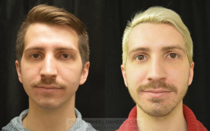 Chin Implant Case 460 Before & After Front | Boston, MA | Christopher J. Davidson, MD