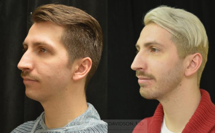 Chin Implant Case 460 Before & After Left Oblique | Boston, MA | Christopher J. Davidson, MD