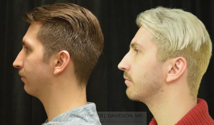 Chin Implant Case 460 Before & After Left Side | Boston, MA | Christopher J. Davidson, MD