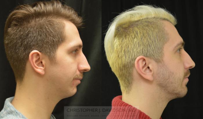 Chin Implant Case 460 Before & After Right Side | Boston, MA | Christopher J. Davidson, MD