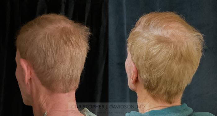 Ear Surgery (Otoplasty) Case 318 Before & After Back - Left Oblique | Boston, MA | Christopher J. Davidson, MD