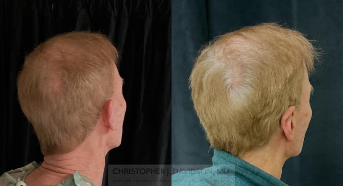 Ear Surgery (Otoplasty) Case 318 Before & After Back - Right Oblique | Boston, MA | Christopher J. Davidson, MD