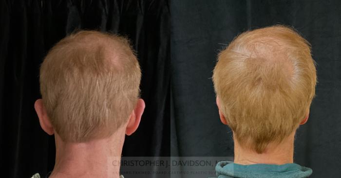 Ear Surgery (Otoplasty) Case 318 Before & After Back | Boston, MA | Christopher J. Davidson, MD