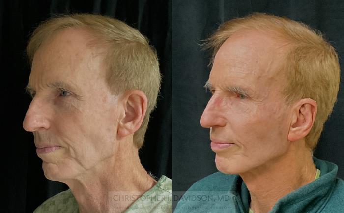 Ear Surgery (Otoplasty) Case 318 Before & After Left Oblique | Boston, MA | Christopher J. Davidson, MD