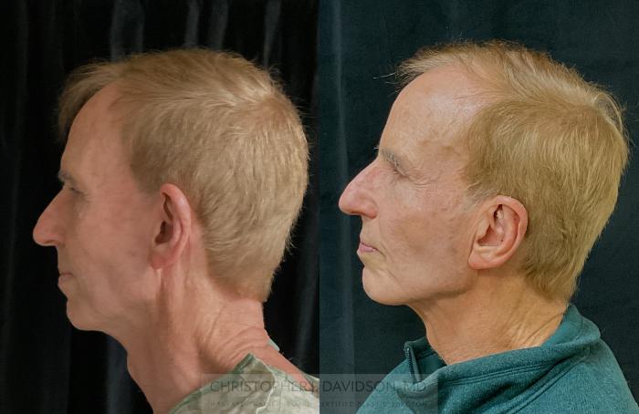Ear Surgery (Otoplasty) Case 318 Before & After Left Side | Boston, MA | Christopher J. Davidson, MD