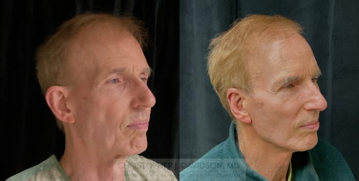 Ear Surgery (Otoplasty) Case 318 Before & After Right Oblique | Boston, MA | Christopher J. Davidson, MD