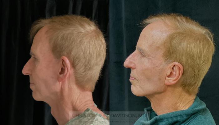 Ear Surgery (Otoplasty) Case 318 Before & After Right Side | Boston, MA | Christopher J. Davidson, MD