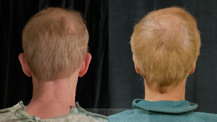 Ear Surgery (Otoplasty) Case 490 Before & After Back | Boston, MA | Christopher J. Davidson, MD