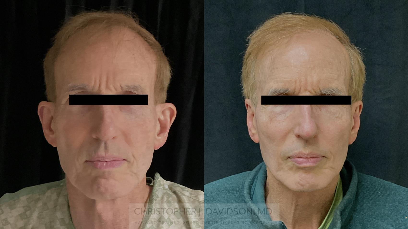 Ear Surgery (Otoplasty) Case 490 Before & After Front | Boston, MA | Christopher J. Davidson, MD