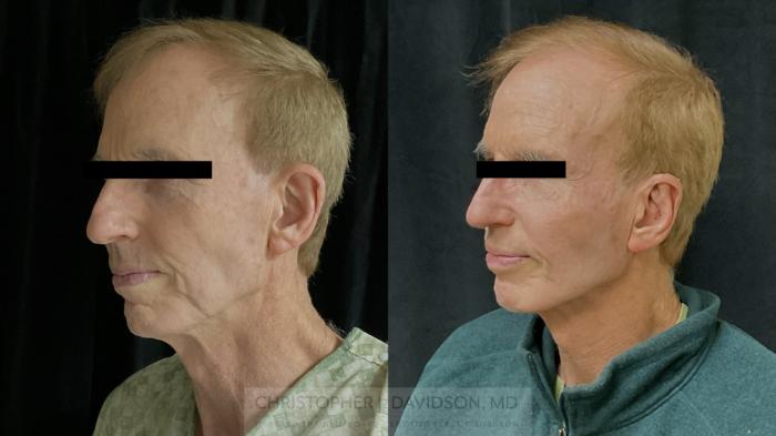 Ear Surgery (Otoplasty) Case 490 Before & After Left Oblique | Boston, MA | Christopher J. Davidson, MD