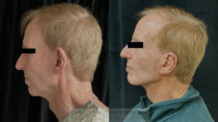 Ear Surgery (Otoplasty) Case 490 Before & After Left Side | Boston, MA | Christopher J. Davidson, MD