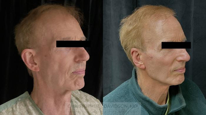 Ear Surgery (Otoplasty) Case 490 Before & After Right Oblique | Boston, MA | Christopher J. Davidson, MD
