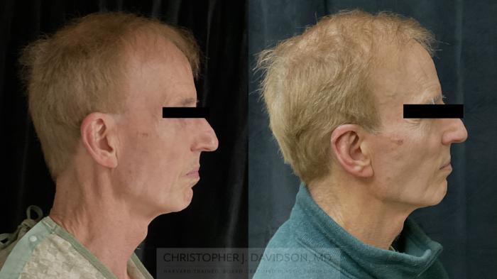Ear Surgery (Otoplasty) Case 490 Before & After Right Side | Boston, MA | Christopher J. Davidson, MD