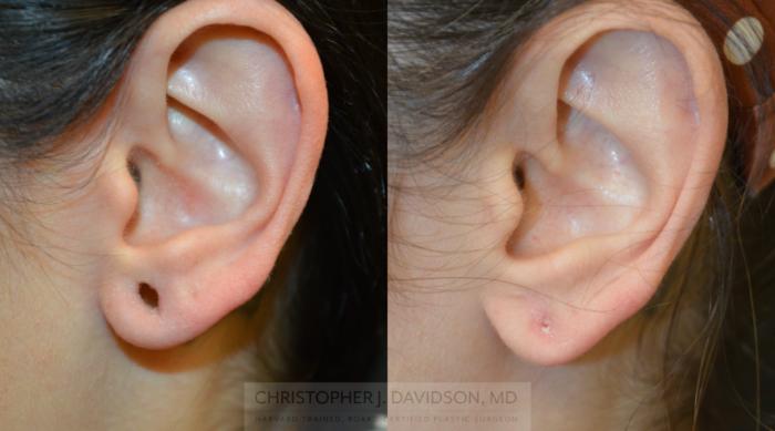 Earlobe Repair Case 321 Before & After Front - left ear | Boston, MA | Christopher J. Davidson, MD