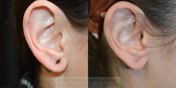 Earlobe Repair Case 321 Before & After Front - Right Earlobe | Boston, MA | Christopher J. Davidson, MD