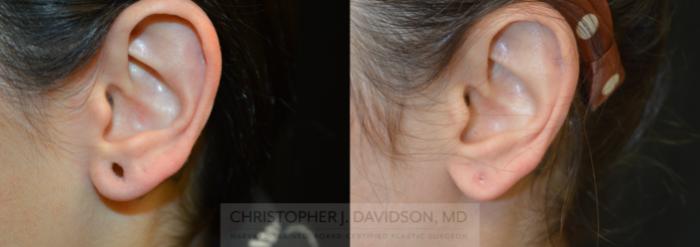 Earlobe Repair Case 463 Before & After Left Side | Boston, MA | Christopher J. Davidson, MD