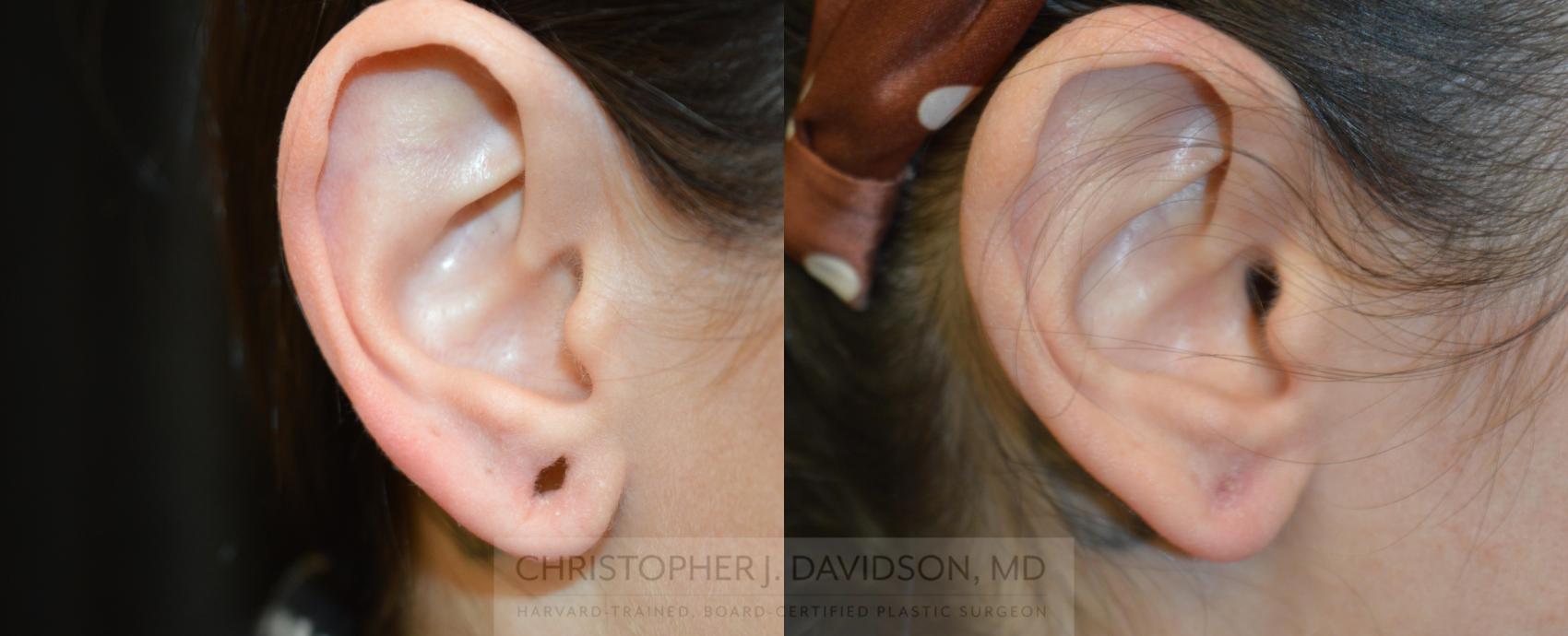 Earlobe Repair Case 463 Before & After Right Side | Boston, MA | Christopher J. Davidson, MD