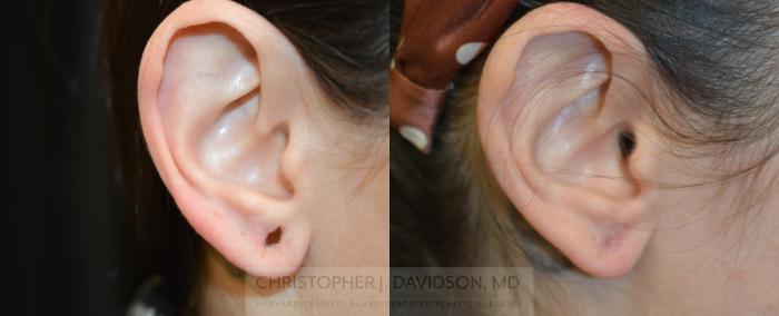 Earlobe Repair Case 463 Before & After Right Side | Boston, MA | Christopher J. Davidson, MD