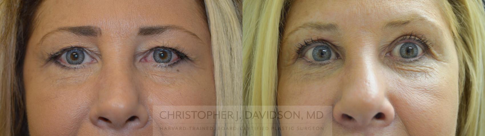 Eyelid Surgery Case 130 Before & After View #1 | Wellesley, MA | Christopher J. Davidson, MD