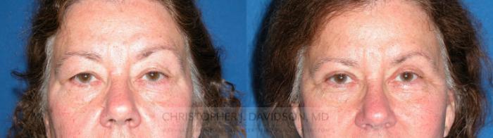 Eyelid Surgery Case 211 Before & After View #1 | Boston, MA | Christopher J. Davidson, MD
