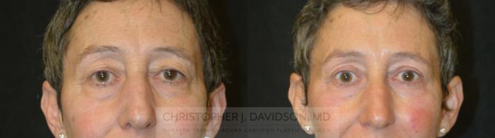 Eyelid Surgery Case 338 Before & After Front | Boston, MA | Christopher J. Davidson, MD