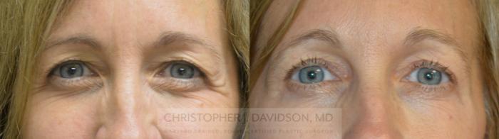 Eyelid Surgery Case 496 Before & After Front | Boston, MA | Christopher J. Davidson, MD