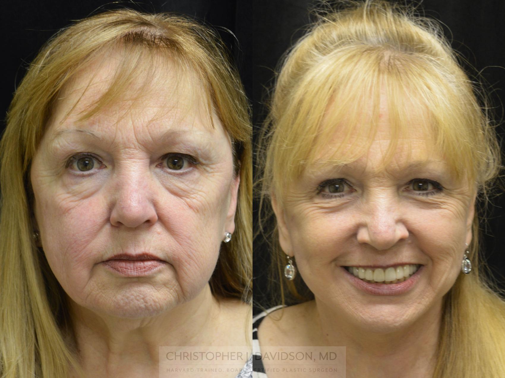 Facelift Surgery Case 154 Before & After View #1 | Wellesley & Boston, MA | Christopher J. Davidson, MD